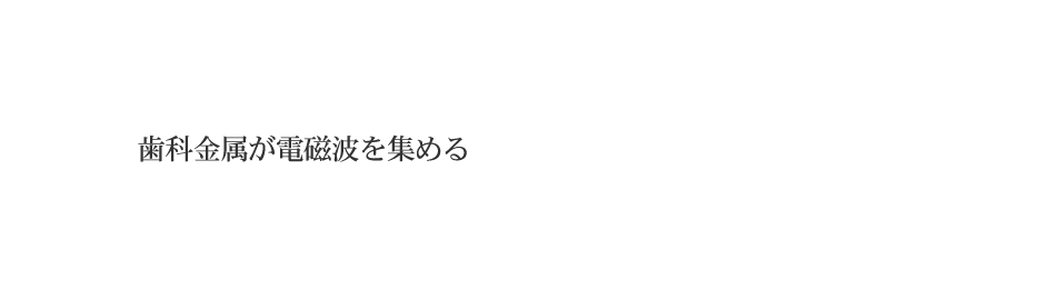 歯科金属が電磁波を集める
